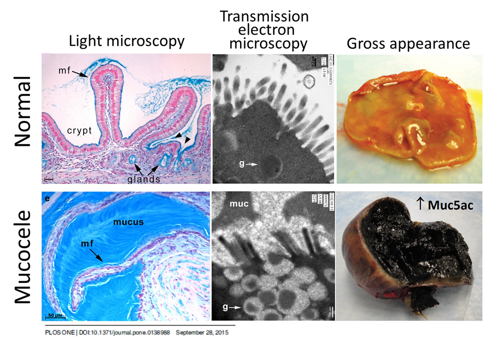 comparison of a normal gallbladder yo a gallbladder mucocele
